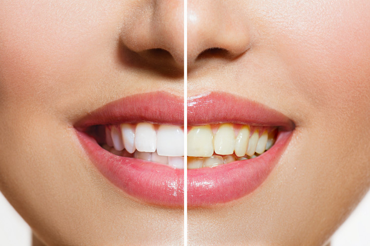 پودرهای سفید کننده دندان چه بلایی بر سر دندان می آورد